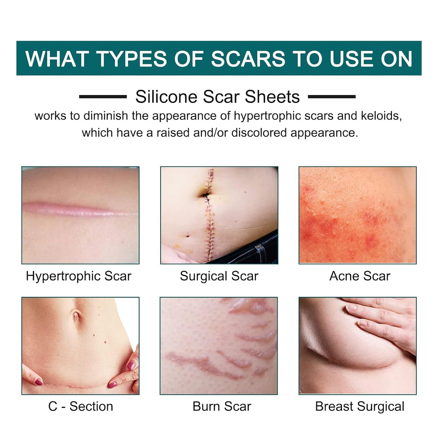 Prestique Silicone Scar Sheets