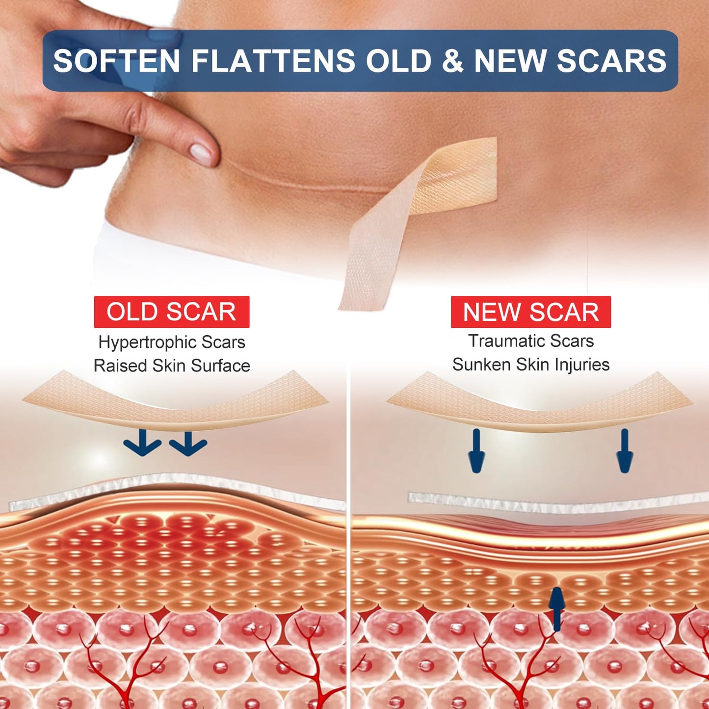 Prestique Silicone Scar Sheets