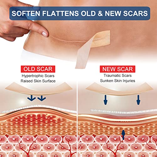Prestique Silicone Scar Sheets