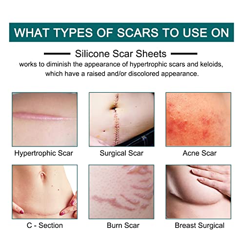 Prestique Silicone Scar Sheets