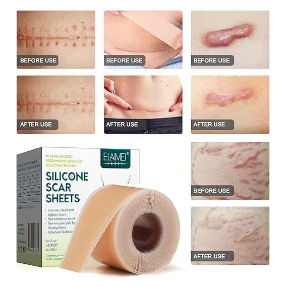 Prestique Silicone Scar Sheets